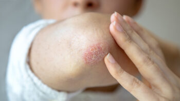 Skin Conditions Explained: Eczema, Psoriasis, and More