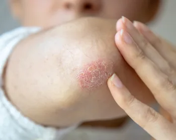 Skin Conditions Explained: Eczema, Psoriasis, and More